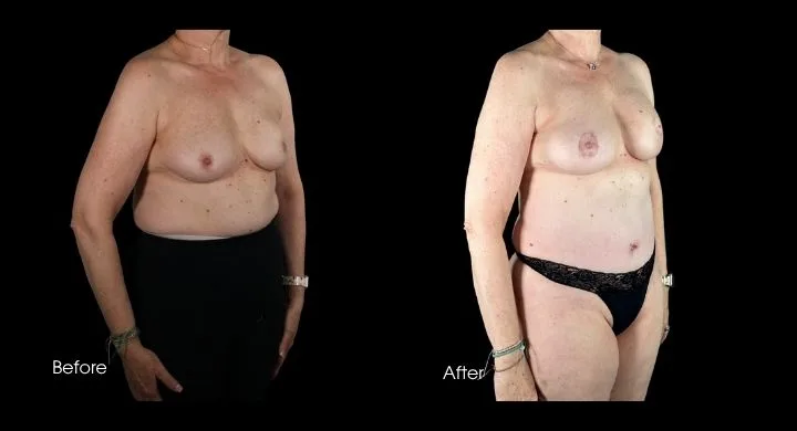 Breast reconstruction before and after using DIEP flap, three-quarter view