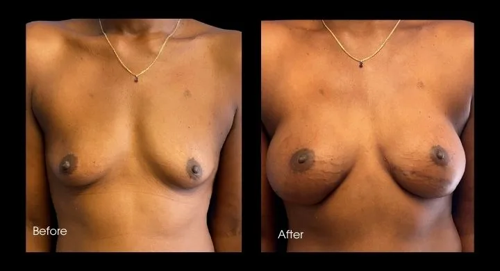 Before and after breast reconstruction with DIEP flap, frontal view showing volume restoration