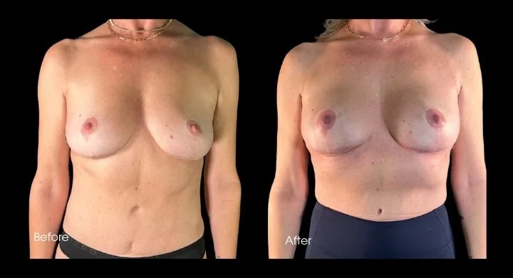 Before and after breast reconstruction with implants, frontal view