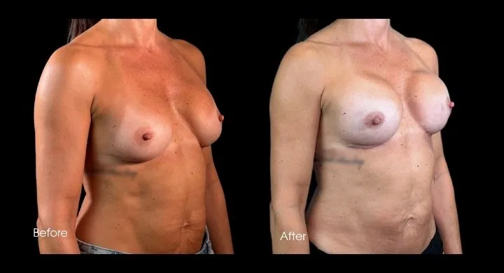 Before and after breast reconstruction with implants, patient shown from front angle