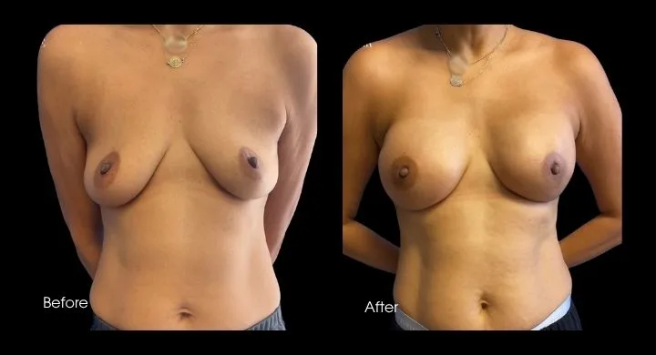 Before and after breast reconstruction with implants, patient shown from front view