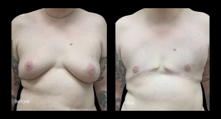 Before and after breast reconstruction following male breast cancer, patient shown from front