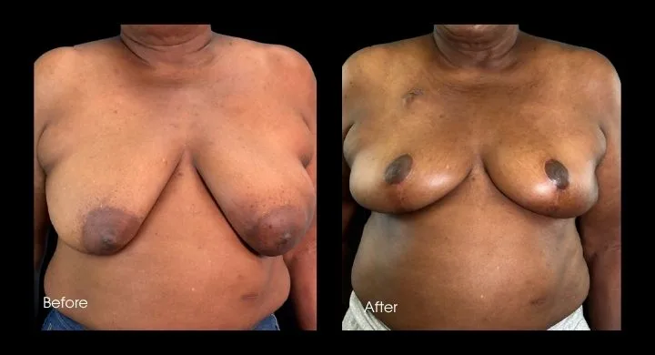 Breast reconstruction before and after oncoplastic reduction, front view