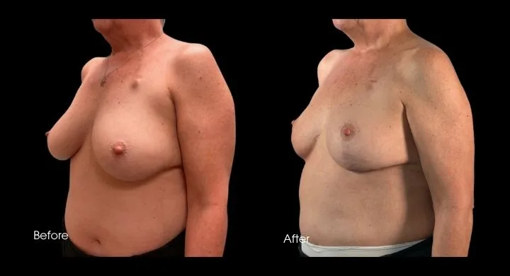 Breast reconstruction before and after oncoplastic reduction, side view