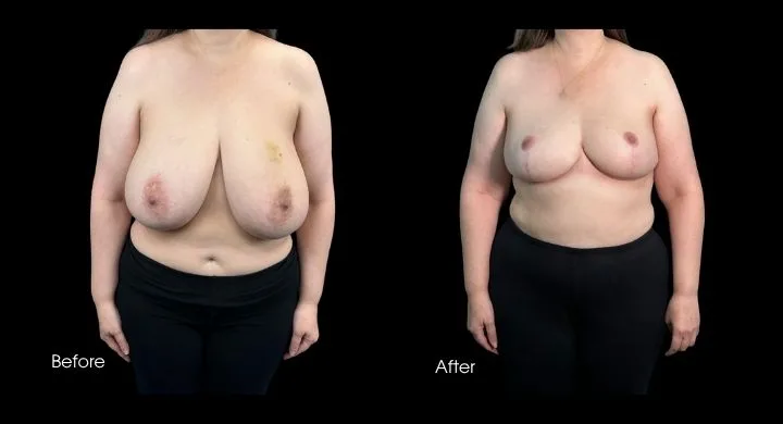 Breast reduction before and after comparison, frontal view