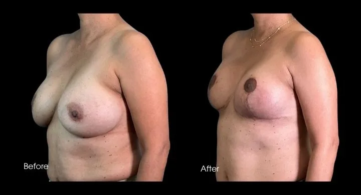 Breast reconstruction before and after comparison, oblique view