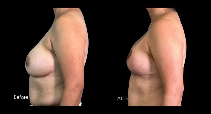 Breast reconstruction before and after comparison, side profile view