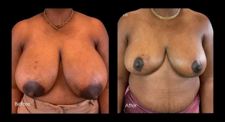 Breast reduction before and after comparison, frontal view