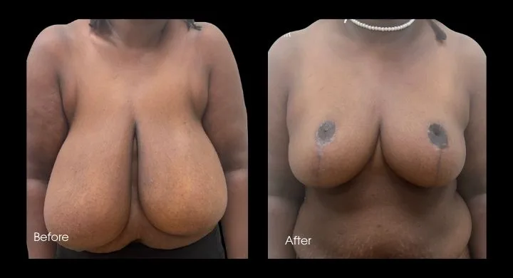 Before and after oncoplastic breast reduction reconstruction, patient shown from front view