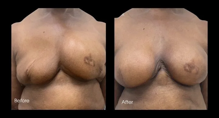 Before and after breast reconstruction revision surgery, patient shown from front angle
