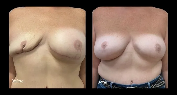 Before and after breast reconstruction using TDAF flap technique