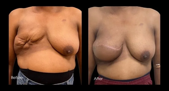 Before and after breast reconstruction using TDAP flap technique, patient shown from front view