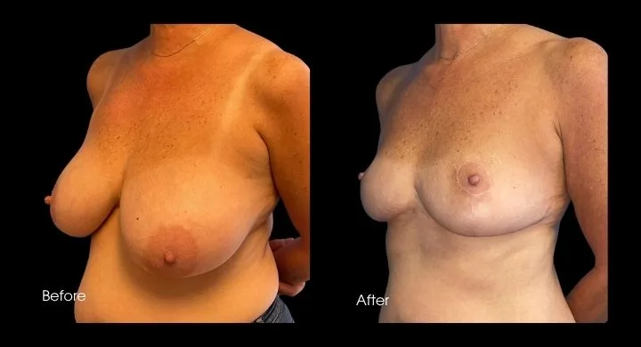Breast reduction before and after, side view showing decreased projection and improved proportion