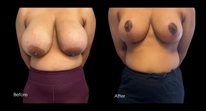 Before and after breast reduction results