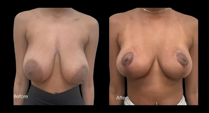 Before and after breast reduction demonstrating size reduction and improved contour