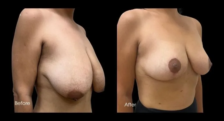 Breast reduction before and after, side view showing reduced volume and improved contour