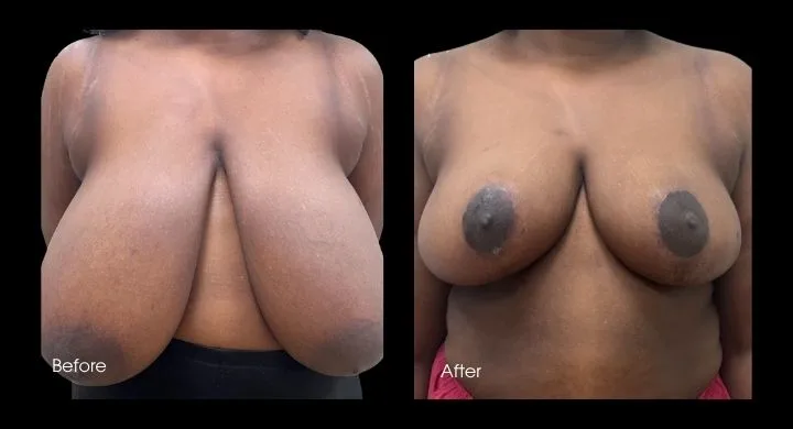 Breast reduction before and after, front view showing reduced size and repositioned areolae