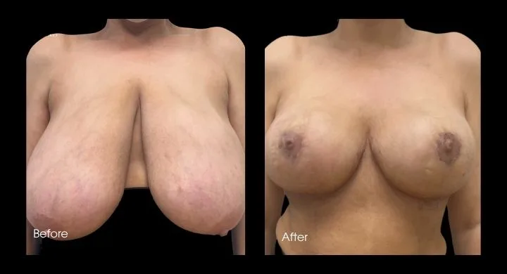 Breast reduction before and after, front view showing decreased volume and lifted appearance