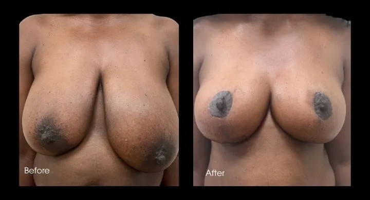 Breast reduction before and after, front view showing reduced size and improved breast shape
