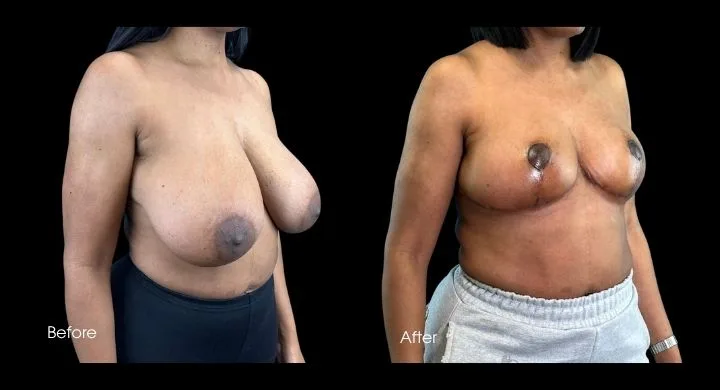 Breast reduction before and after comparison, side angle view