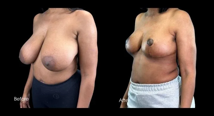 Breast reduction before and after case 2: frontal view showing reduced breast size and improved contour
