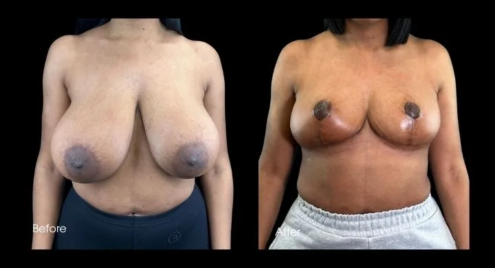Breast reduction before and after case 2: frontal view demonstrating volume reduction and repositioned nipple-areola