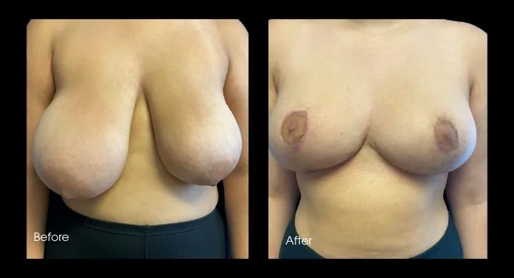 Before and after breast reduction surgery