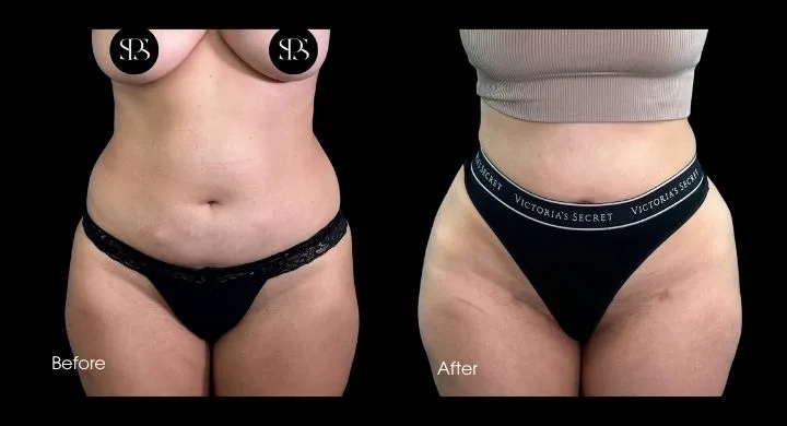 Before and after liposuction: frontal view showing reduced abdominal and hip contours