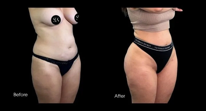 Before and after liposuction: frontal view showing reduced midsection and hip definition