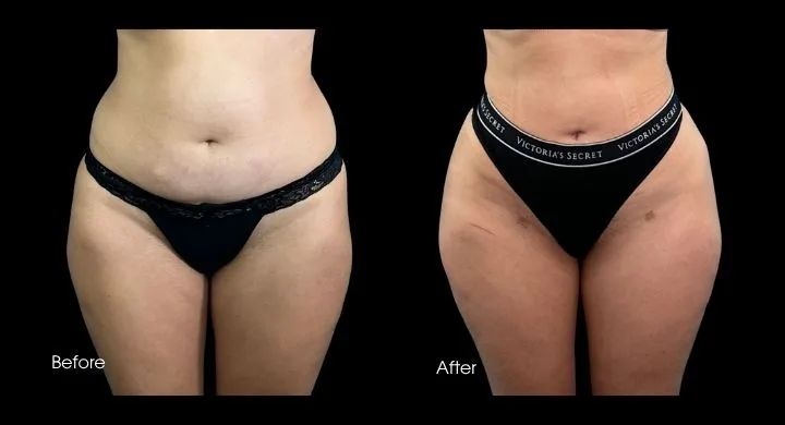 Before and after 360-degree liposuction: frontal view showing refined abdominal and hip contours