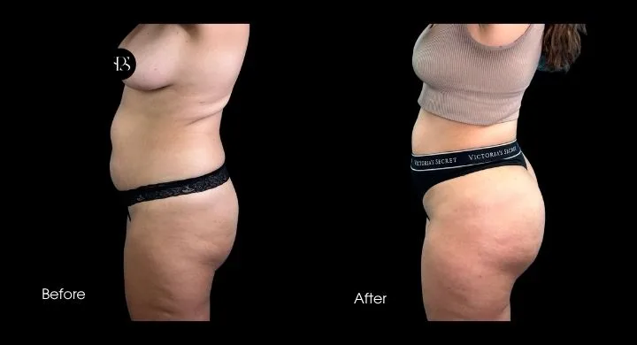 Before and after liposuction: side view showing reduced abdominal and flank fullness