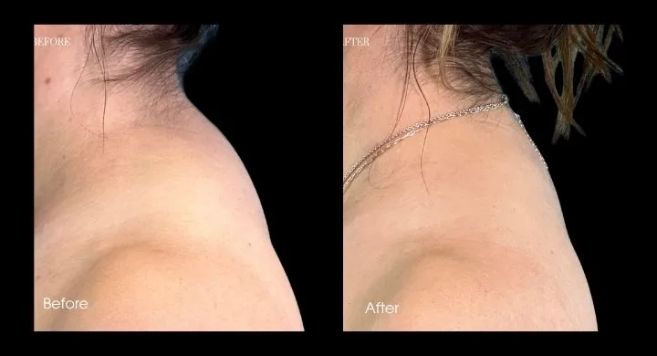 Liposuction before and after case 1: side profile of neck and jawline showing reduced fullness
