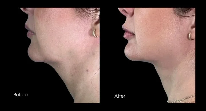 Liposuction before and after case 1: profile view of lower face and neck with improved definition
