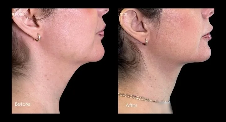 Liposuction before and after case 1: side profile of jawline and neck showing enhanced contour