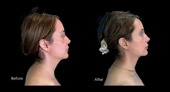 Liposuction before and after, profile view showing improved jawline and neck definition