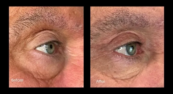 Lower blepharoplasty before and after case 1: close-up of eye area showing reduced under-eye puffiness and wrinkles