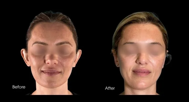 Before and after otoplasty, frontal view showing ear position correction