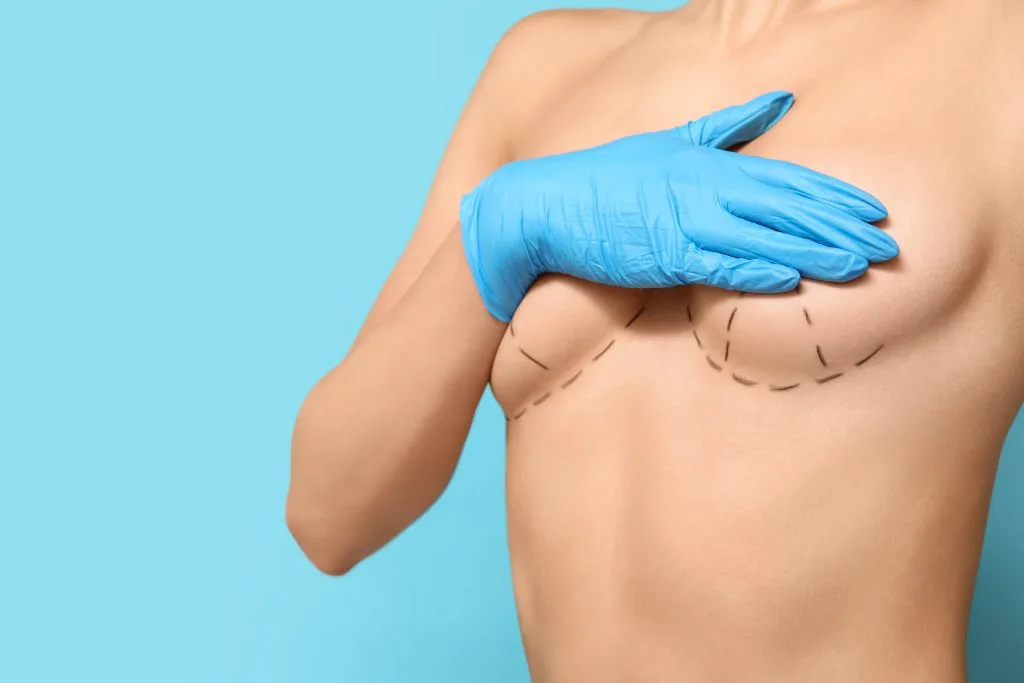 Surgeon in blue gloves marking breast with surgical lines for cosmetic procedure planning