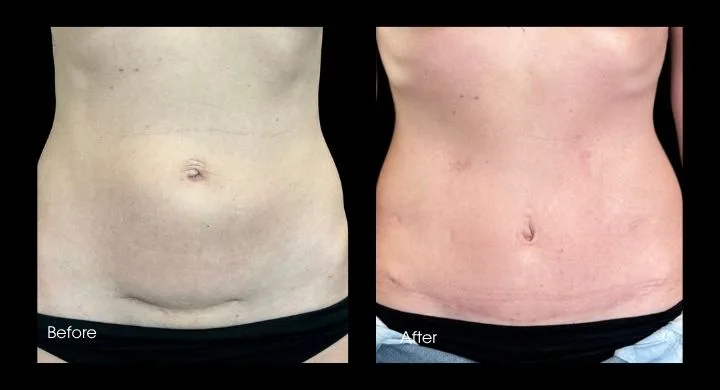 Tummy tuck before and after, front view: smoother abdominal surface with minimal scarring