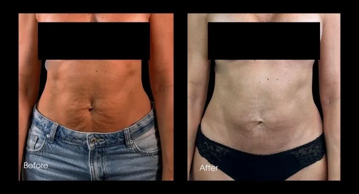 Tummy tuck before and after, front view: tightened midsection with improved waistline definition
