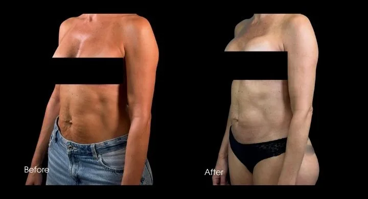 Tummy tuck before and after, side view: enhanced abdominal profile and body contour