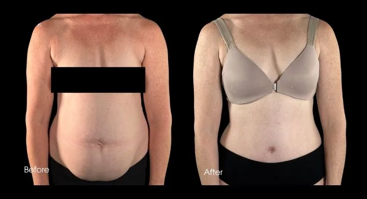 Tummy tuck before and after, front view: reduced abdominal fullness with refined torso shape