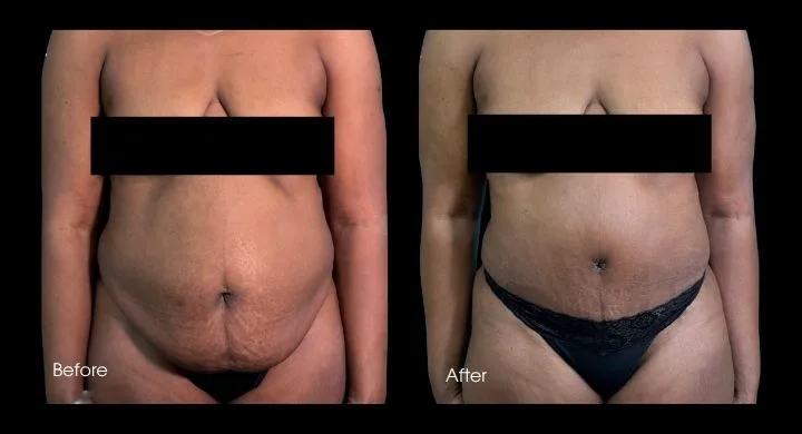 Before and after tummy tuck showing flattened abdomen and improved abdominal contour