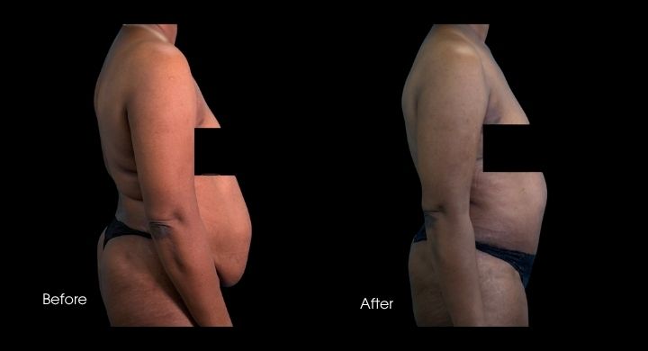 tummy-tuck-case-7-2