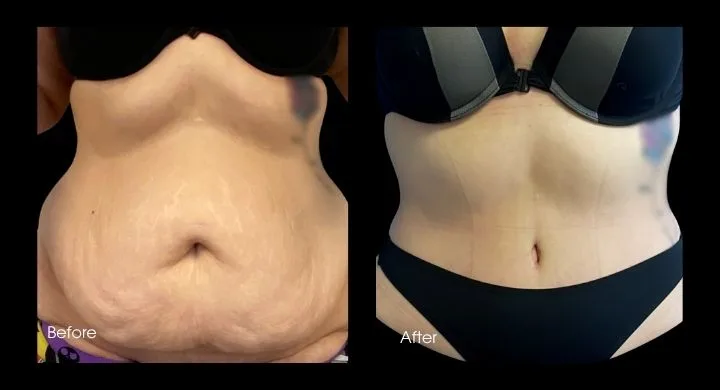 Before and after tummy tuck: frontal view showing flattened abdomen and improved contour