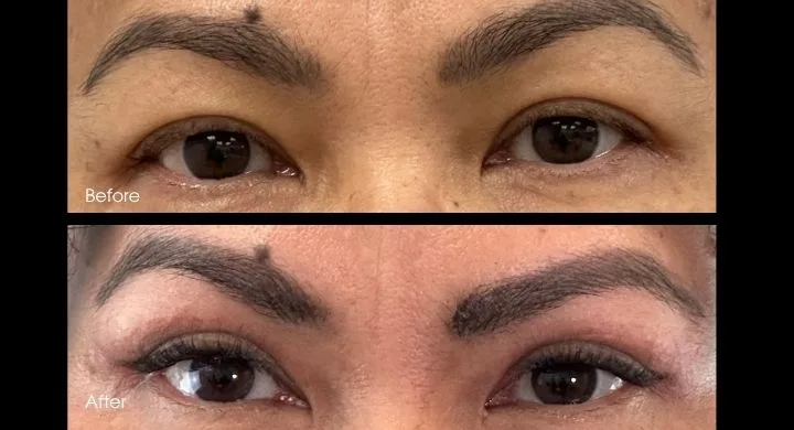 Before and after upper blepharoplasty showing reduced upper eyelid drooping and improved eye opening