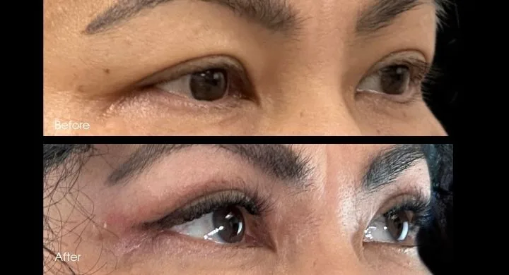 Before and after upper blepharoplasty showing lifted eyelids with enhanced eye contour