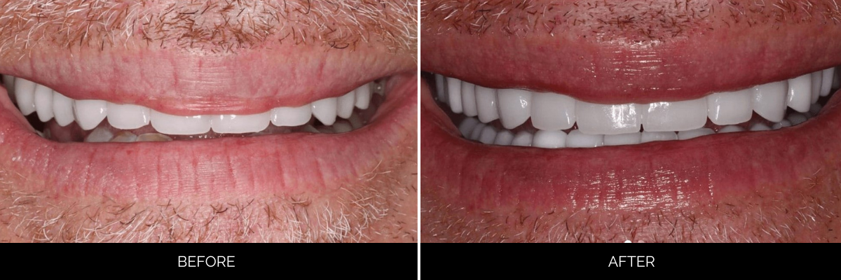 Before and after cosmetic dental treatment with whitened, reshaped front teeth