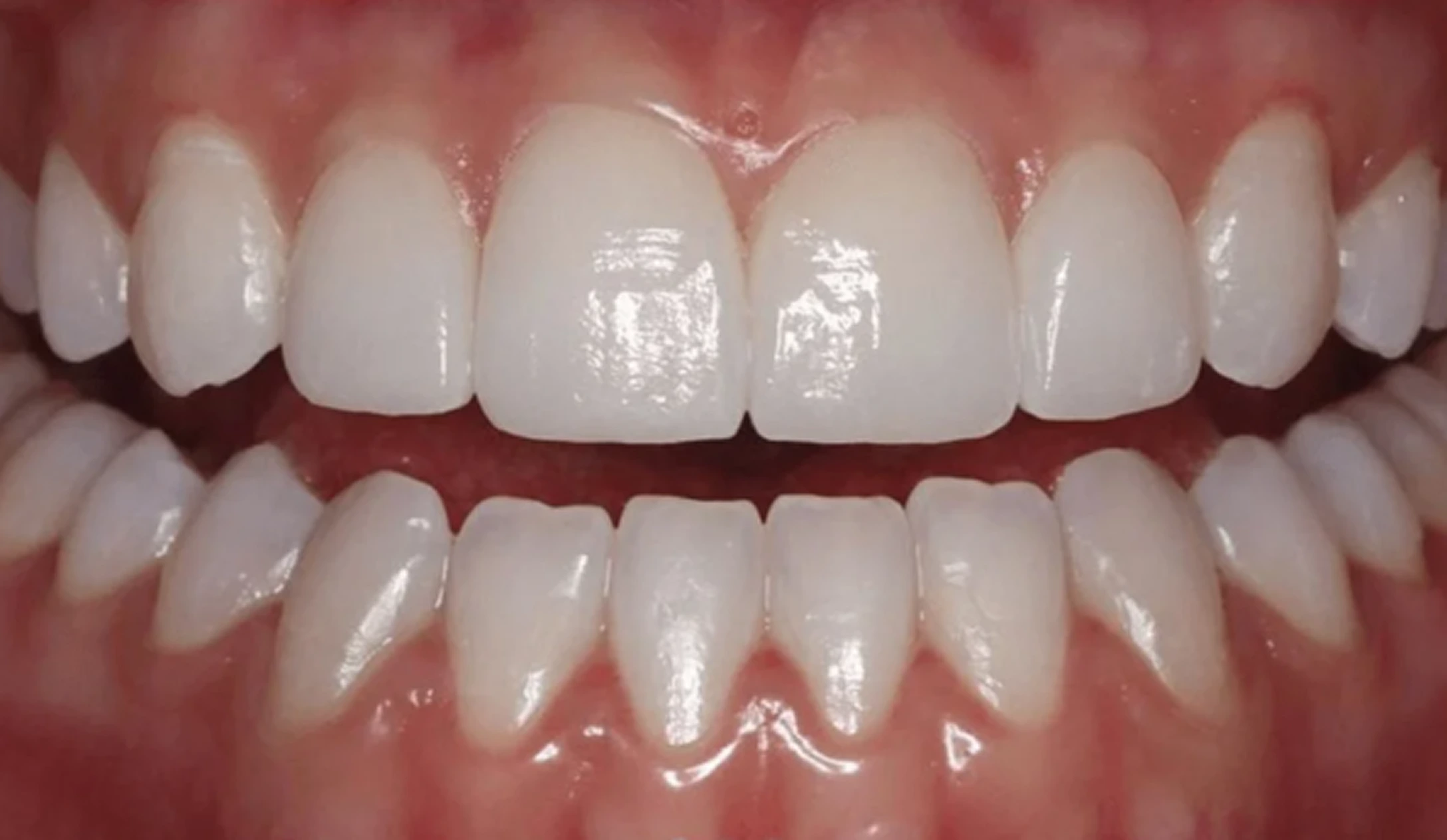 Close-up of a patient's bright, uniformly white porcelain veneers on upper and lower front teeth