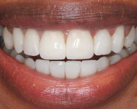 Anti Aging Dentofacial Lift 1 After - Cosmetic Dental Studios NYC